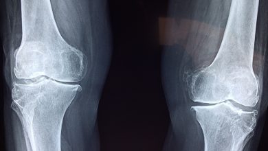 Effects of Aging on Bones and the Available Solutions 8 an image of x ray showing bones