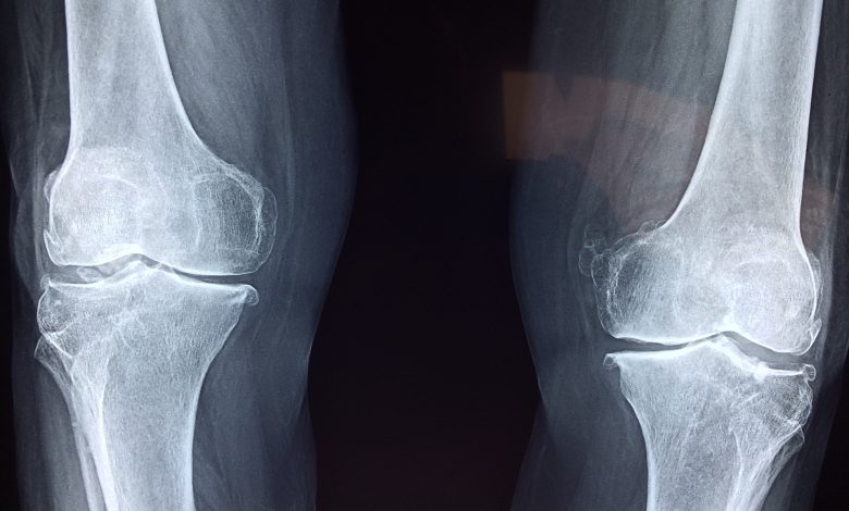 Effects of Aging on Bones and the Available Solutions 1 an image of x ray showing bones