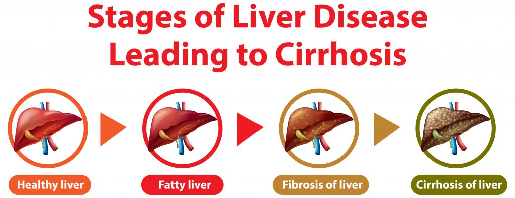 Little-Known Facts About Liver Aging. 8 Steps To Be Taken To Slow Down Aging. 3 liver cirrhosis and liver aging