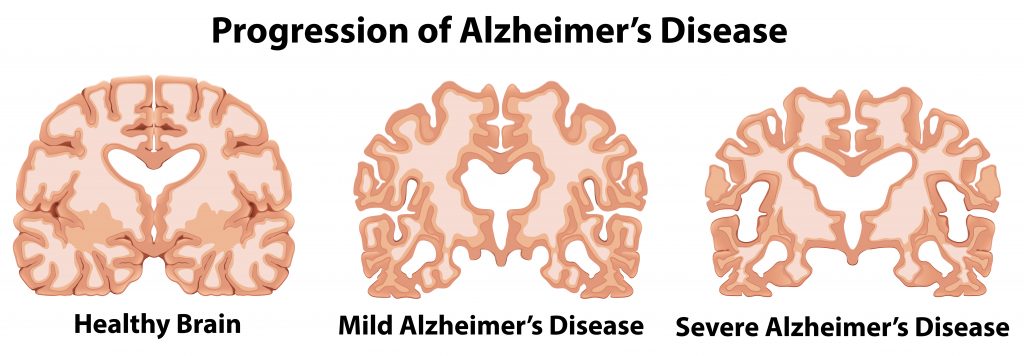 Alzheimer's disease