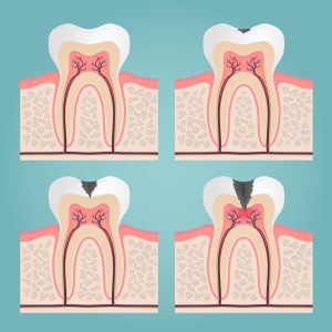 Aging & Oral Health. How to Avoid Losing Teeth At an Old Age? 4 oral health and cavity