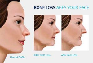 Aging & Oral Health. How to Avoid Losing Teeth At an Old Age? 2 oral health and bone structure
