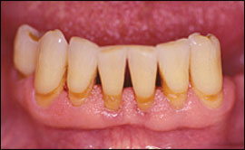 Aging & Oral Health. How to Avoid Losing Teeth At an Old Age? 3 gingivitis for oral health