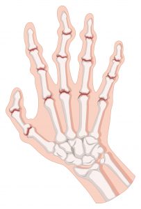 Rheumatoid arthritis manifestation in hands 