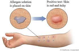 A Guide to Allergies, What Are the Types, Causes and Management. 4 patch testing for allergies