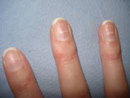 23 Signs of Nutrient Deficiency in The Body and Thier Soultion. 3 deficiency