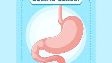 stomach cancer