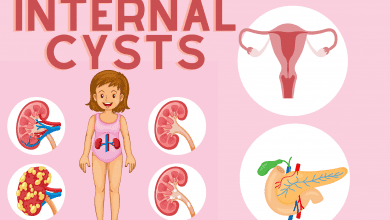 Internal Cysts