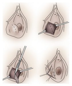 The Top 5 Internal Cysts & Thier Research Based Treatments. 5 cyst treatment