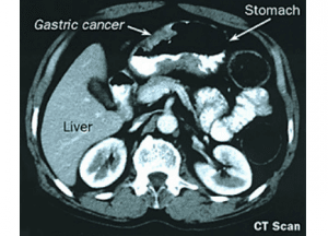 Understanding Stomach Cancer. What Are the Risks, Treatment & Prevention? 3 radiological interpretation of gastric cancer in CT scan