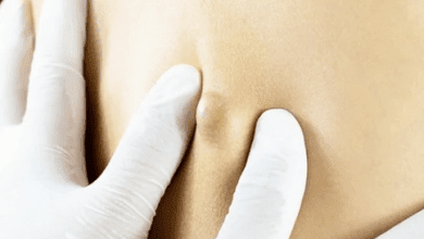 cysts on skin