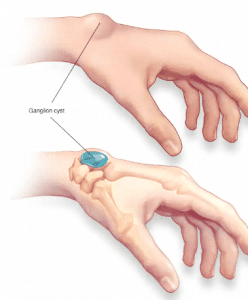Cysts on Skin. When to Worry and Get Treated? 6 a ganglion cysts on skin