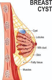 The Top 5 Internal Cysts & Thier Research Based Treatments. 2 breasts cysts