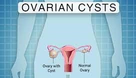 The Top 5 Internal Cysts & Thier Research Based Treatments. 4 ovaran cysts