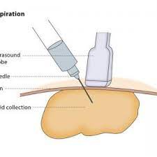 The Top 5 Internal Cysts & Thier Research Based Treatments. 3 aspiration of cyst