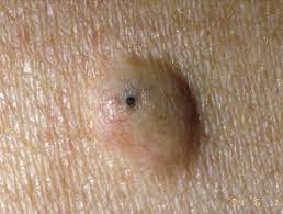 Cysts on Skin. When to Worry and Get Treated? 2 epidermoid cyst