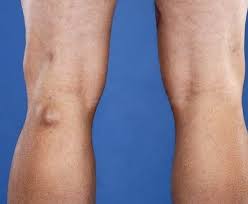 Cysts on Skin. When to Worry and Get Treated? 8 an image of baker cycts on skin