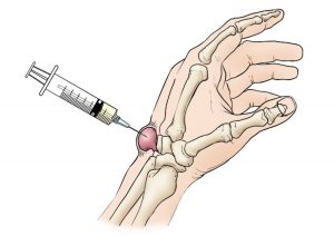 Cysts on Skin. When to Worry and Get Treated? 7 ganglion cyst aspiration final