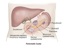 The Top 5 Internal Cysts & Thier Research Based Treatments. 6 pancreatic cysts