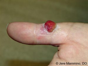 Cysts on Skin. When to Worry and Get Treated? 5 pyogenic granuloma