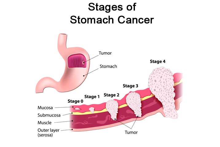 Understanding Stomach Cancer. What Are the Risks, Treatment & Prevention? 4 stomach-cancer-stages