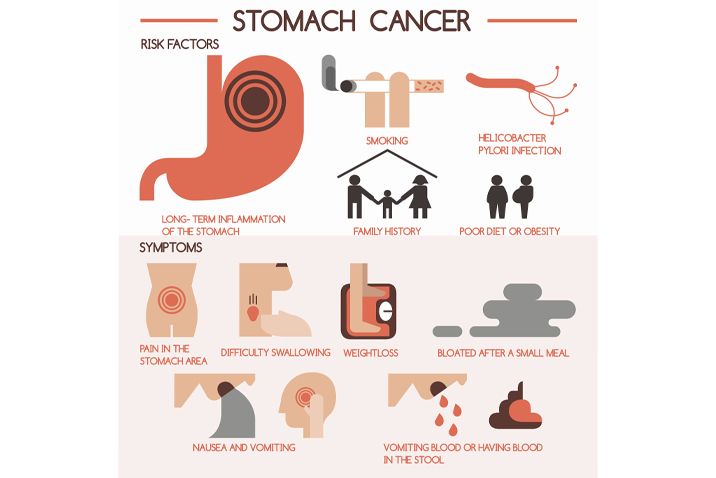 Understanding Stomach Cancer. What Are the Risks, Treatment & Prevention? 2 stomach-cancer-symptoms
