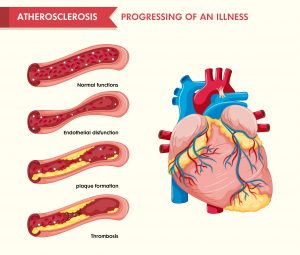 Why is Cholesterol Important for Human body? Some facts. 4 cholesterol in arteries