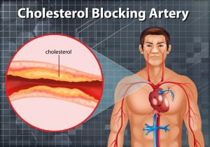 Diagram showing cholesterol blocking artery in human body