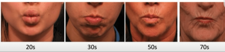 Facial Aging Explained. The Top 8 Aging Changes Proven By Researches. 5 facial aging and changes in lips.