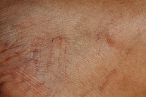 Facial Aging Explained. The Top 8 Aging Changes Proven By Researches. 4 Facial Aging and blood vessels