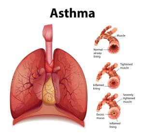Asthma 