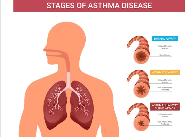 asthma
