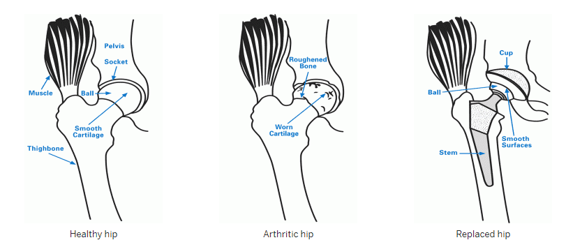 A Comprehensive Guide on Joint Replacement Surgery. 4 joint replacement