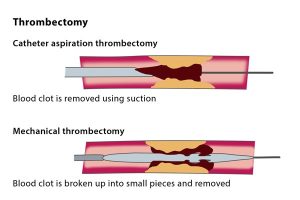 Thrombectomy600x400