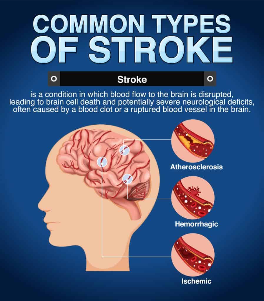 types of strokes