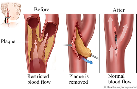 stroke treatment 