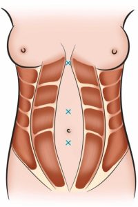 Post-Pregnancy Belly Transformation- Exercises and 6 Quick Tips for a Stronger Postpartum Abdomen 2 1 s2.0 S1748681523003224 gr4