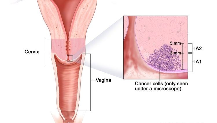 cervical cancer 