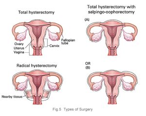 What is The Best Treatment of Cervical Cancer? A Guideline to Preventing Cervical Cancer. 3 cervical cancer surgery types kkh