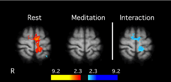 The Power of Meditation- Proven Practices for Mind and Body Wellness 2 Interaction between meditation and pain related brain activation in MRI session 2